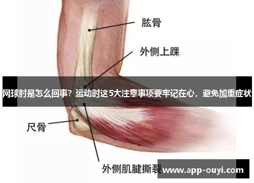 网球肘是怎么回事？运动时这5大注意事项要牢记在心，避免加重症状